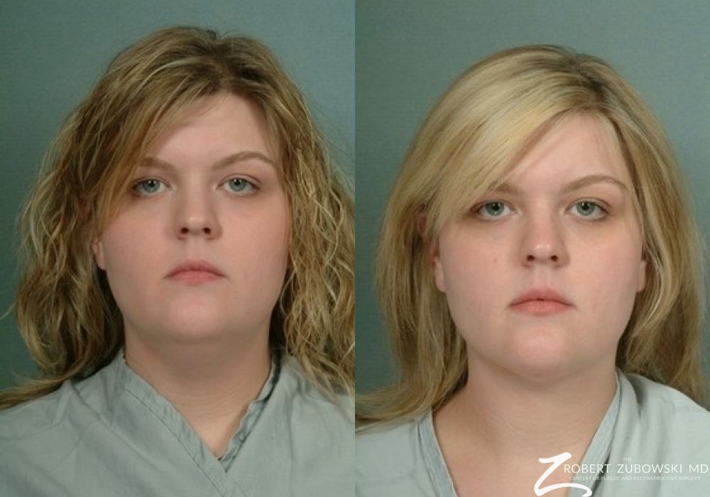 Liposuction - Case 3526