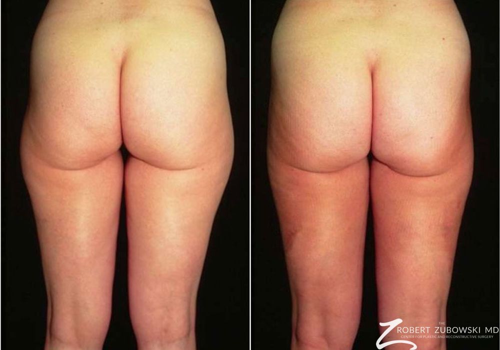 Liposuction - Case 3559