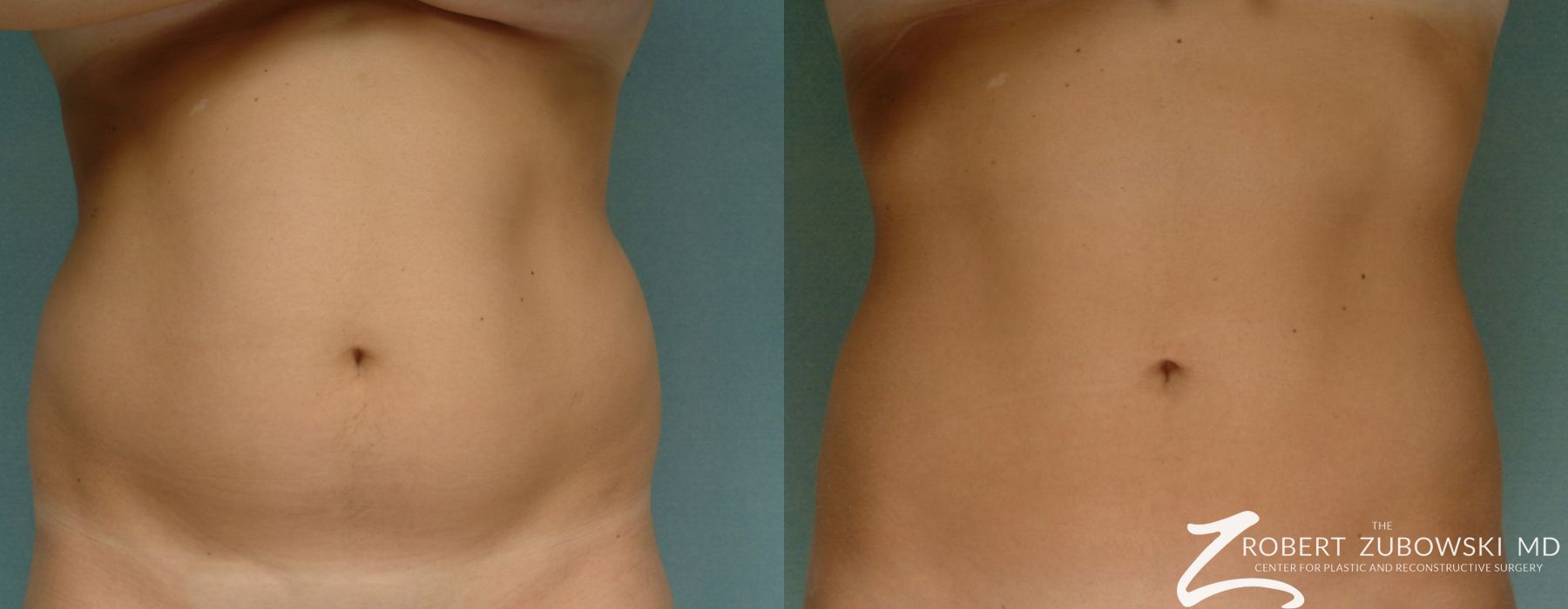 Liposuction - Thumbnail 2