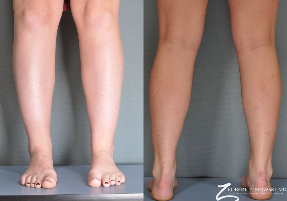 Liposuction - Thumbnail 2