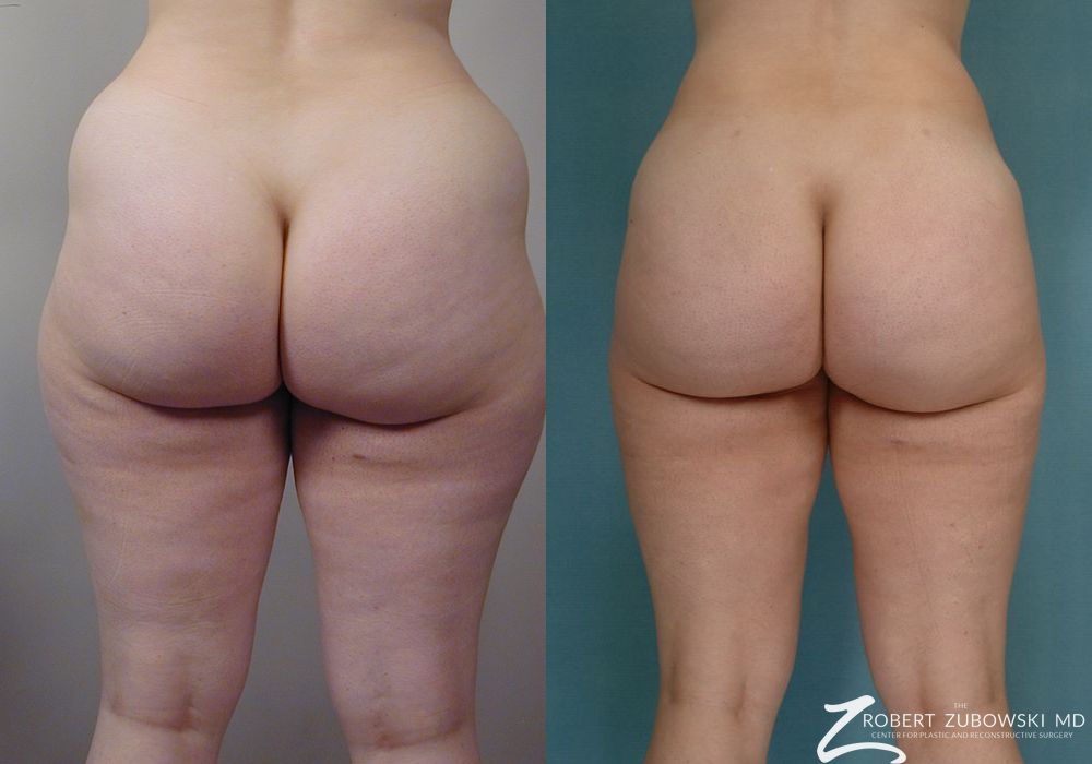 Liposuction - Thumbnail 5