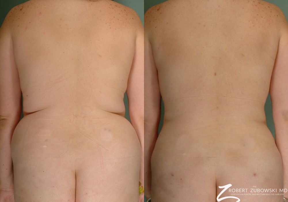 Liposuction - Case 3546