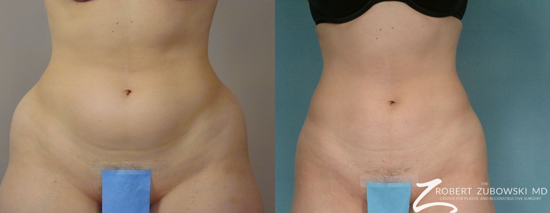 Liposuction - Thumbnail 3