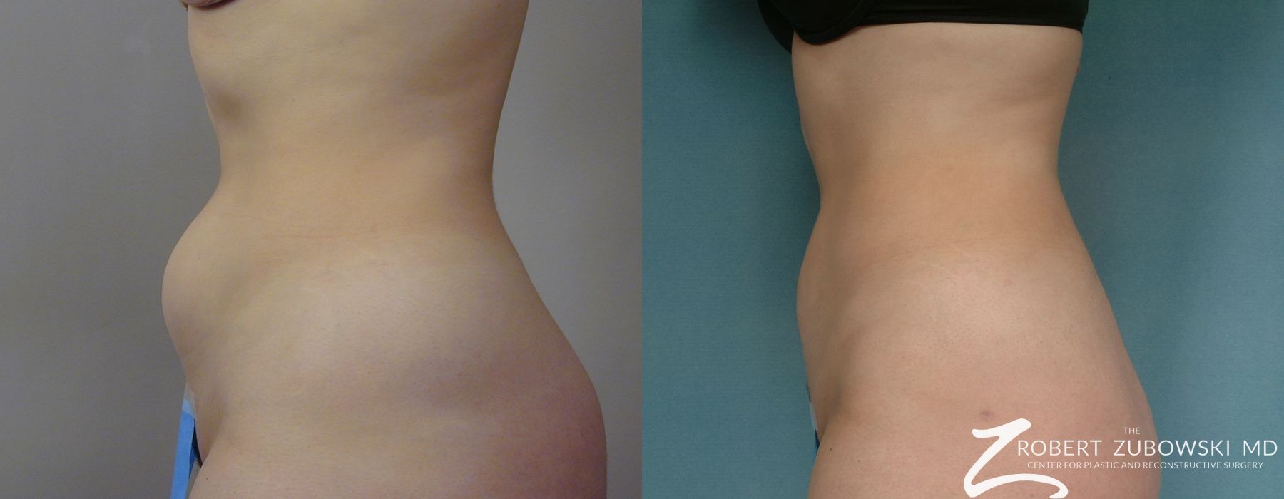 Liposuction - Thumbnail 4