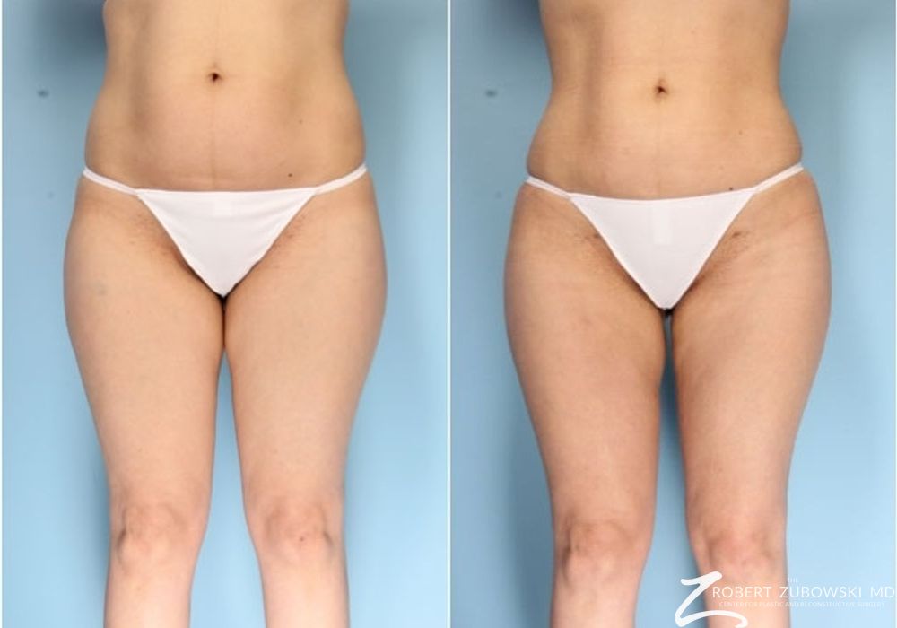 Liposuction - Case 3563