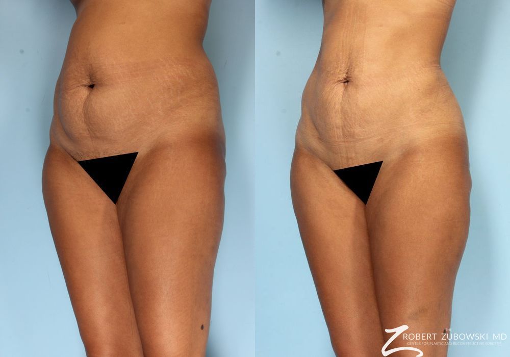 Liposuction - Thumbnail 2