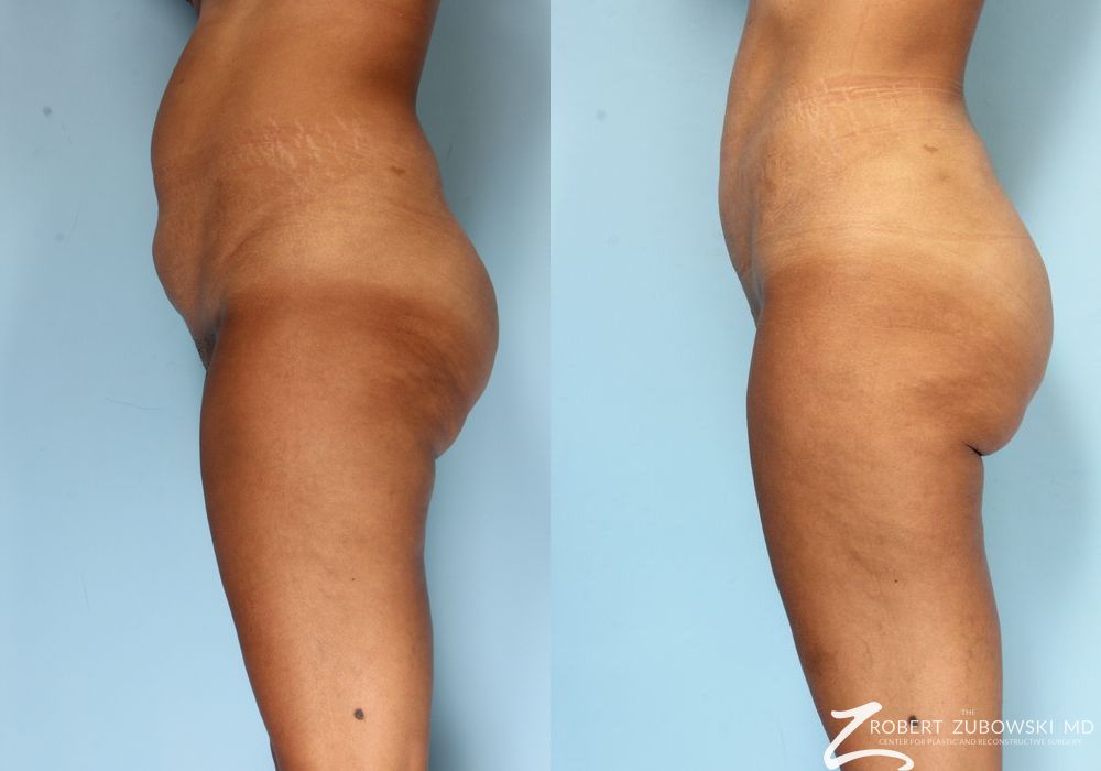 Liposuction - Thumbnail 3