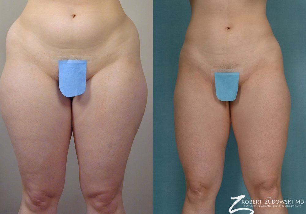 Liposuction - Case 3550