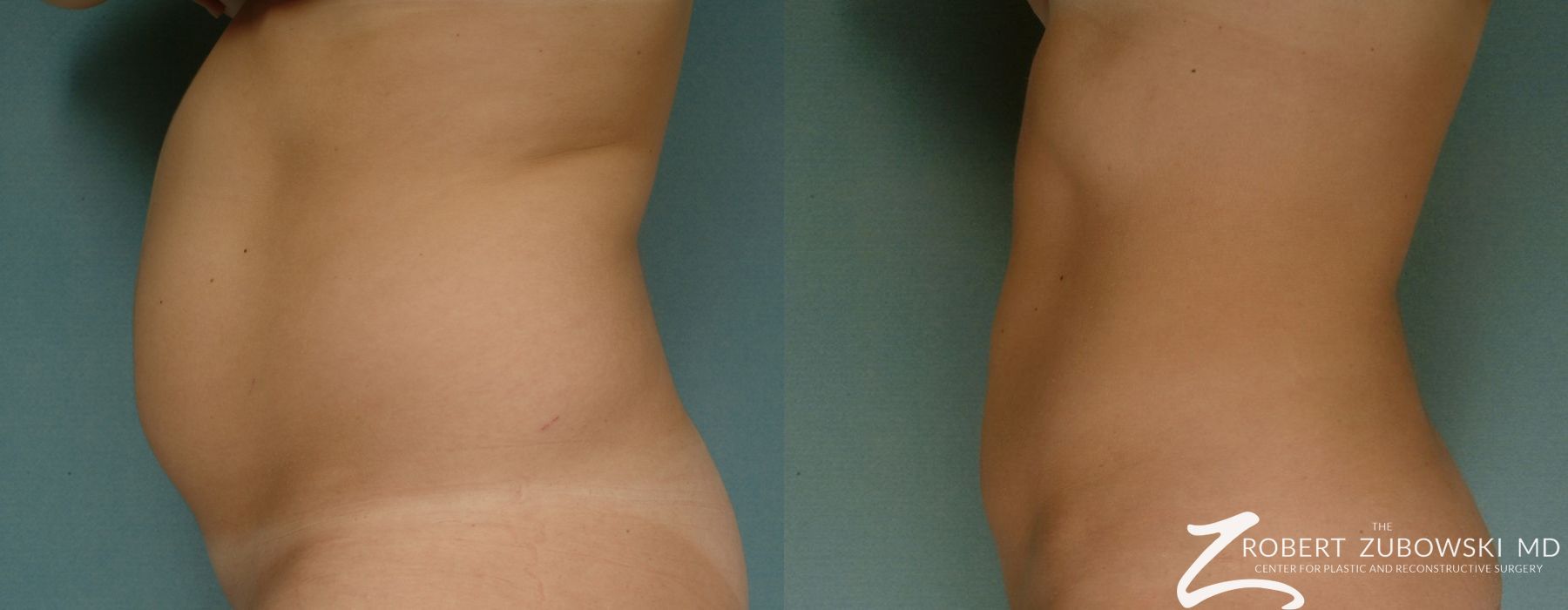 Liposuction - Case 3991