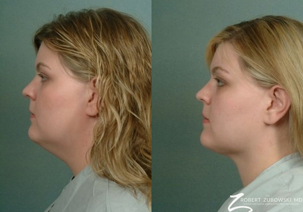 Liposuction - Thumbnail 2