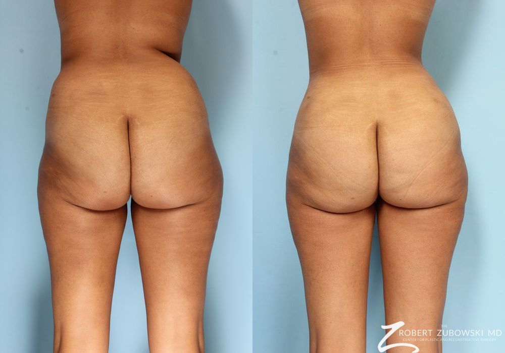 Liposuction - Thumbnail 4