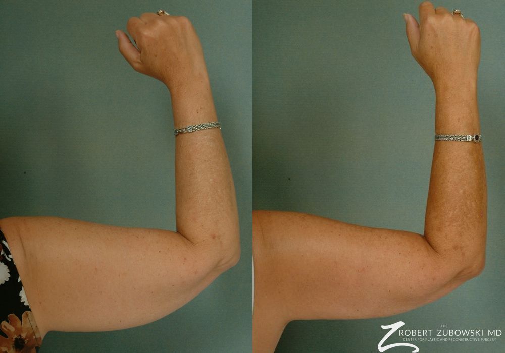 Liposuction - Case 3544