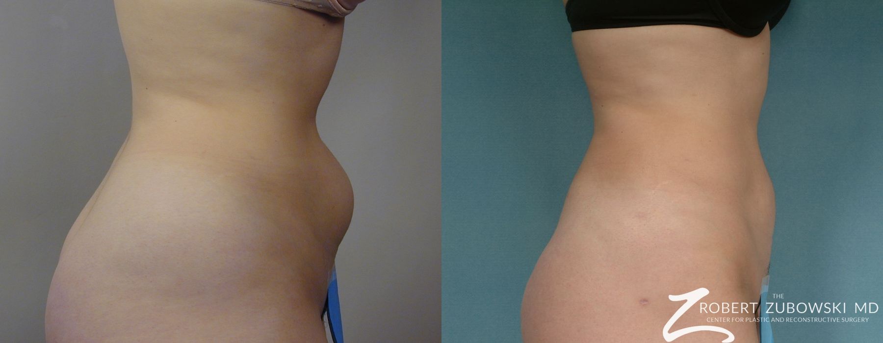 Liposuction - Thumbnail 2