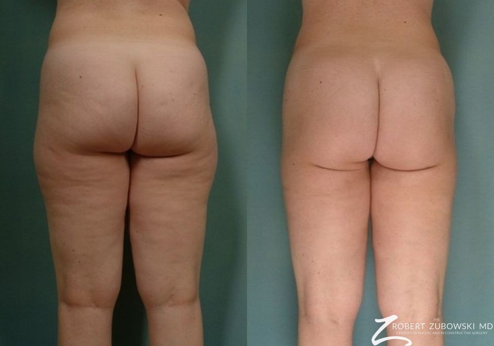 Liposuction - Thumbnail 2