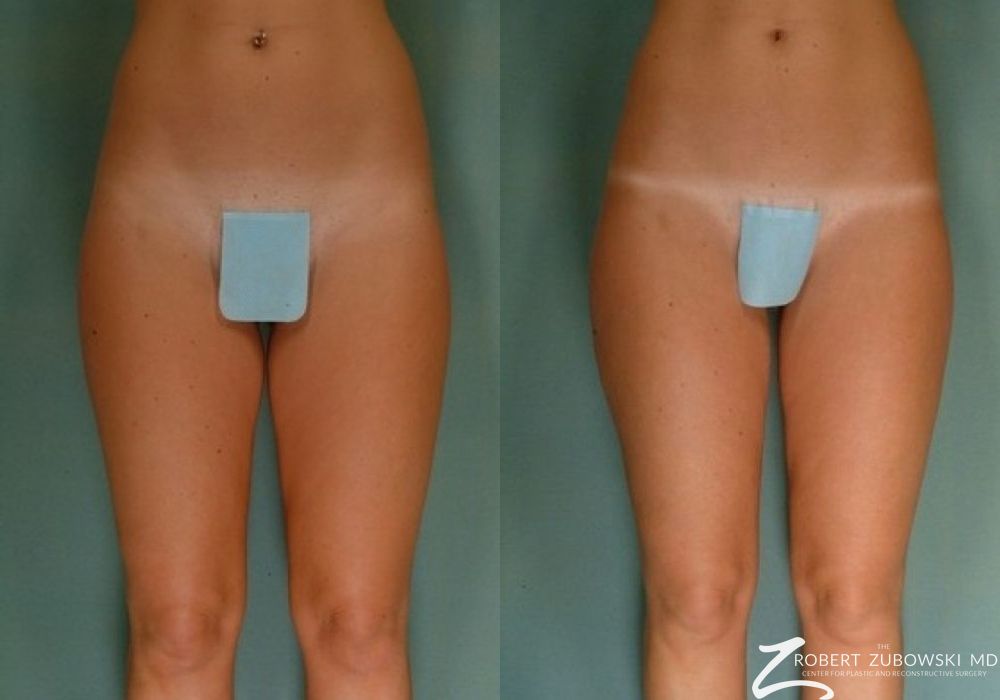 Liposuction - Case 3528