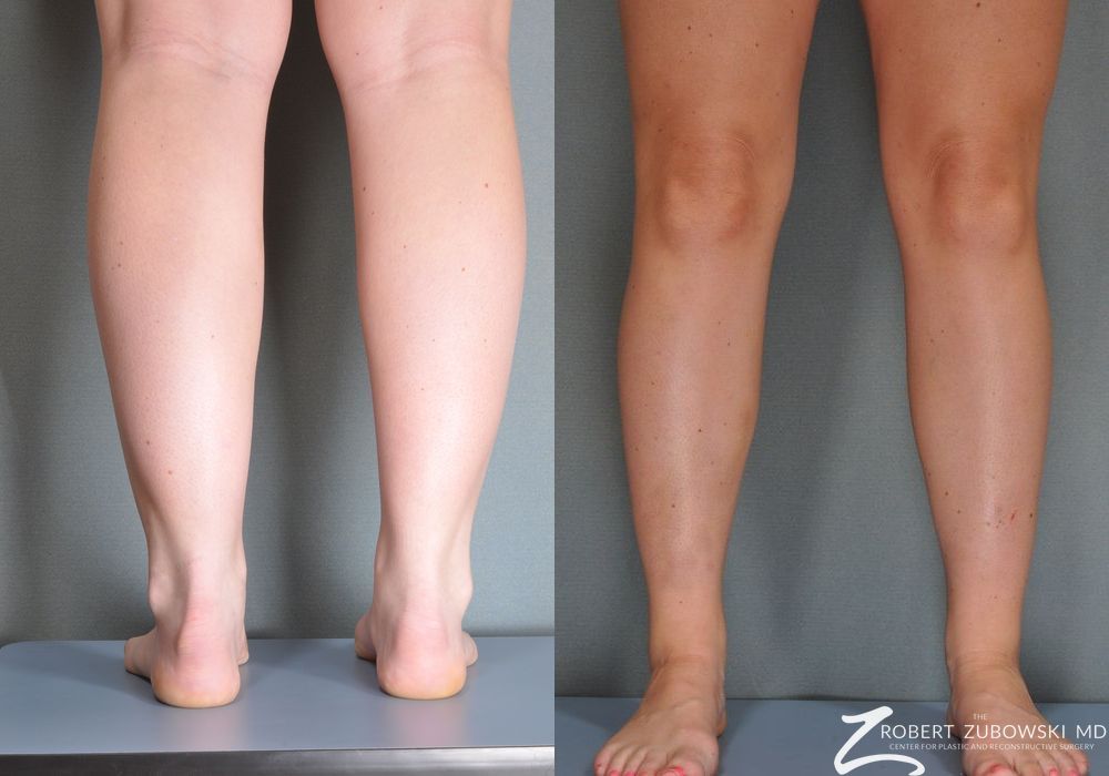 Liposuction - Case 3542