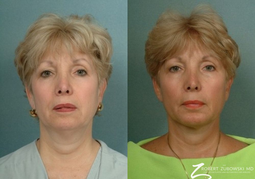 Chin Augmentation - Case 3524