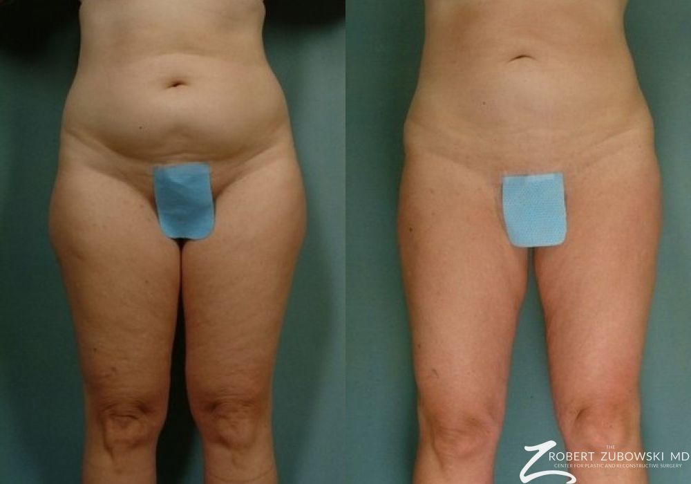 Liposuction - Case 3527