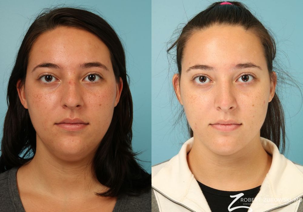 Liposuction of the Neck - Case 3832