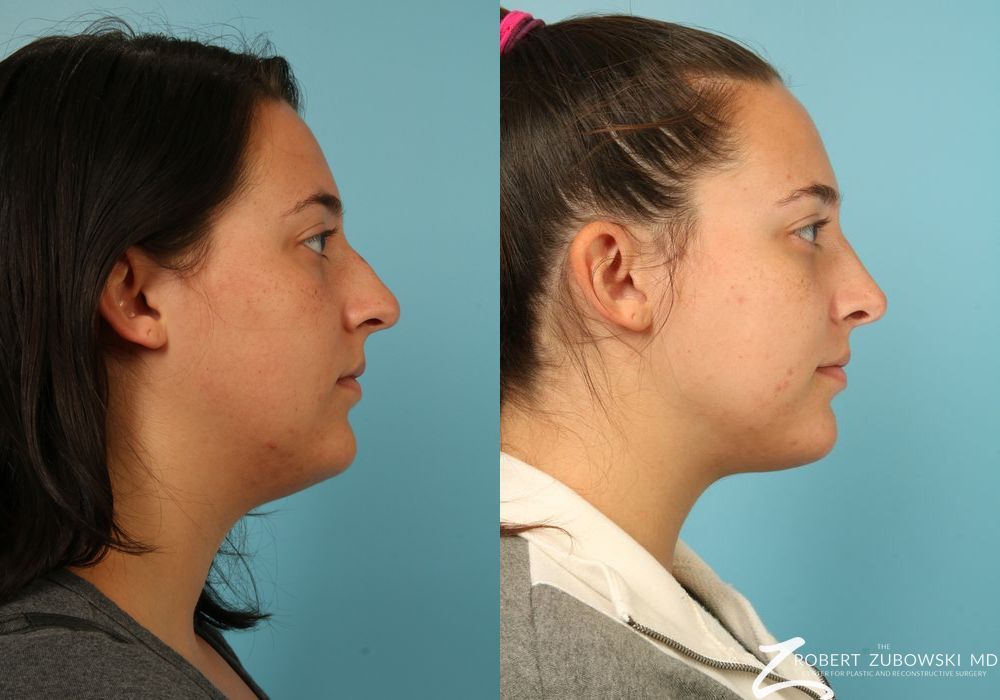 Liposuction of the Neck - Thumbnail 2