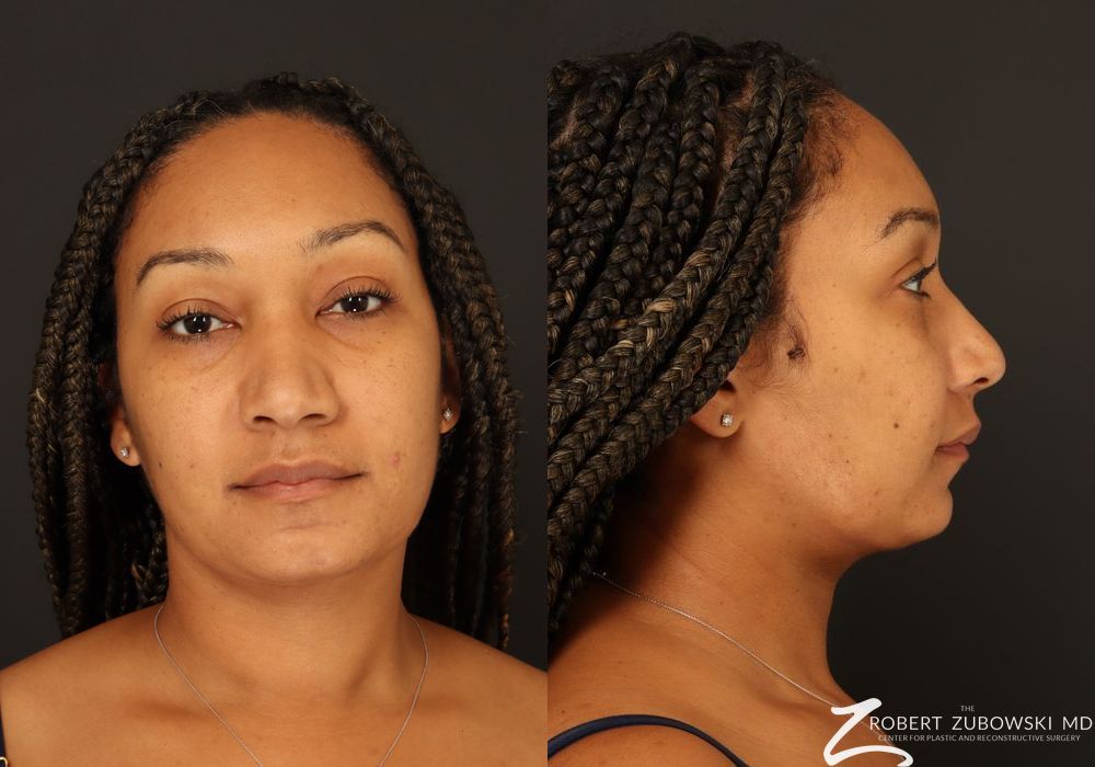 Liposuction of the Neck - Thumbnail 2