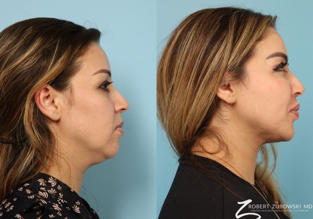 Liposuction of the Neck - Thumbnail 2