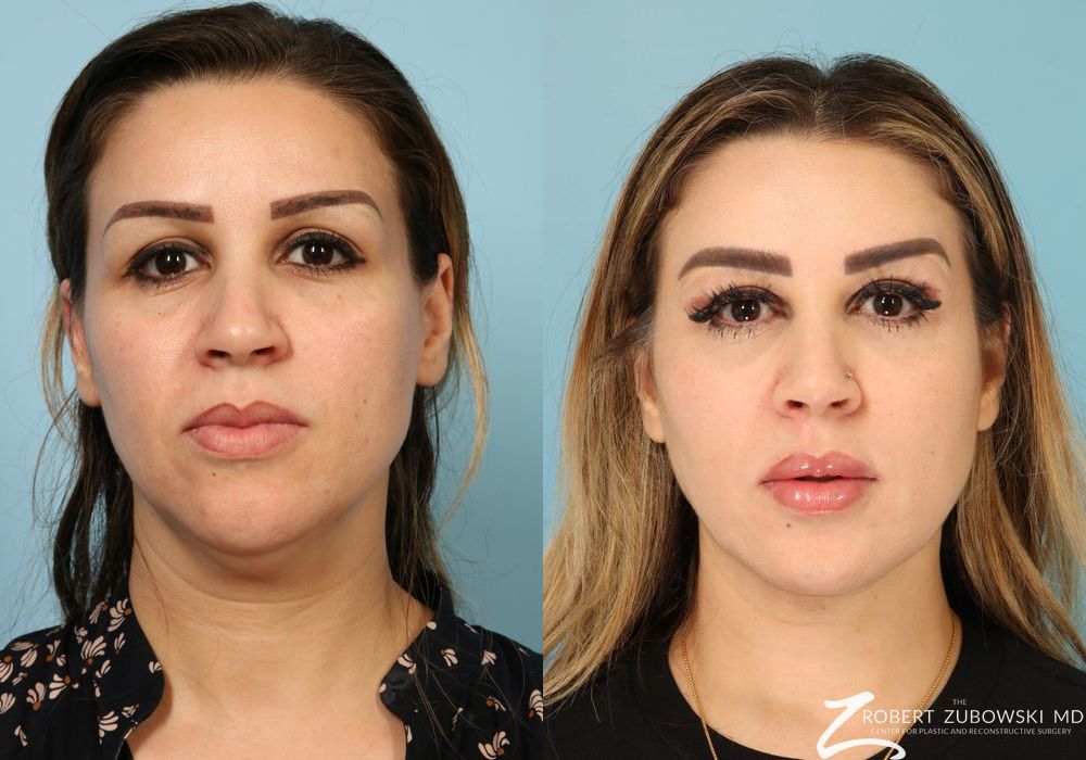 Liposuction of the Neck - Case 3833