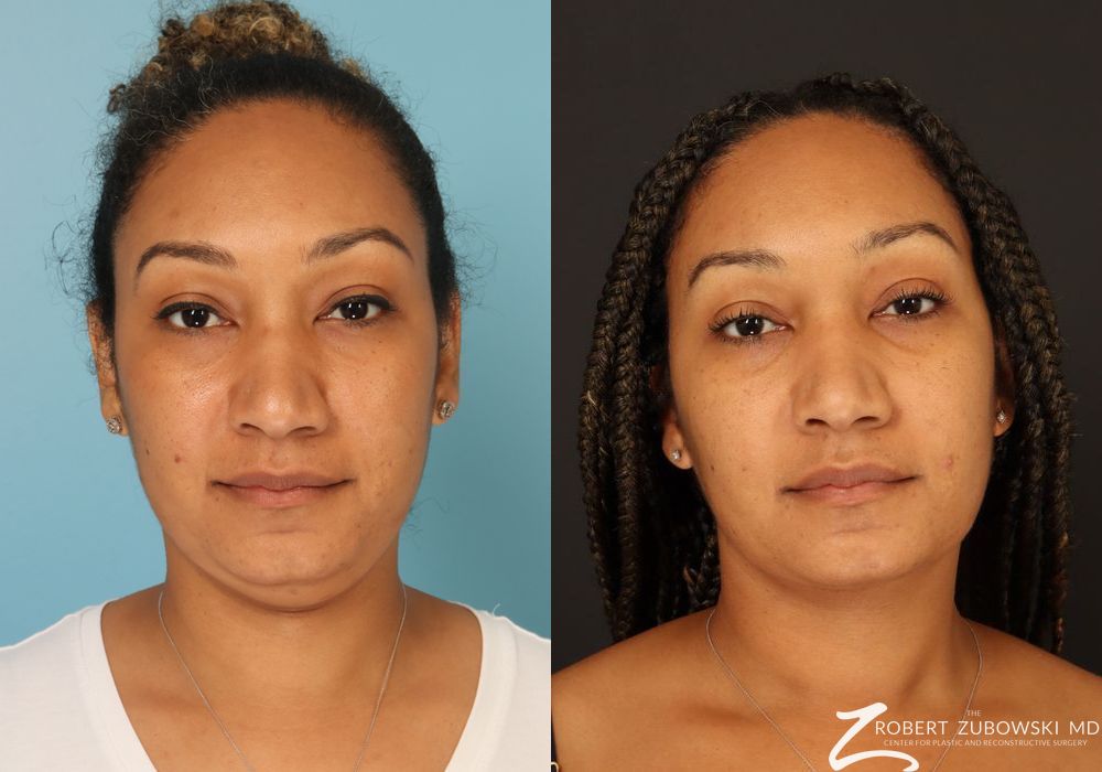 Liposuction of the Neck - Case 3834