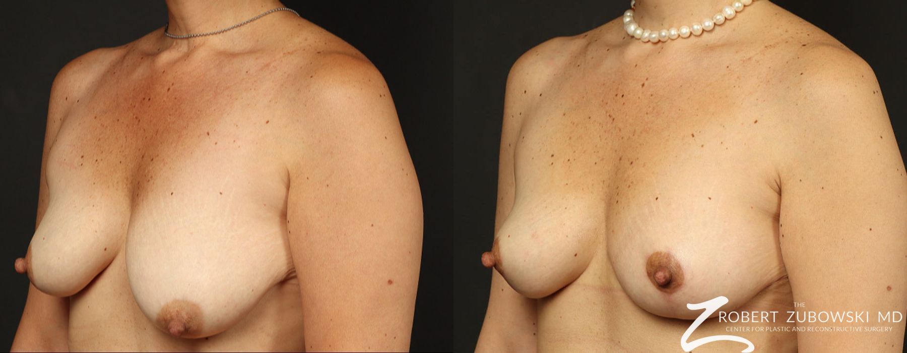 Mastopexy - Thumbnail 2