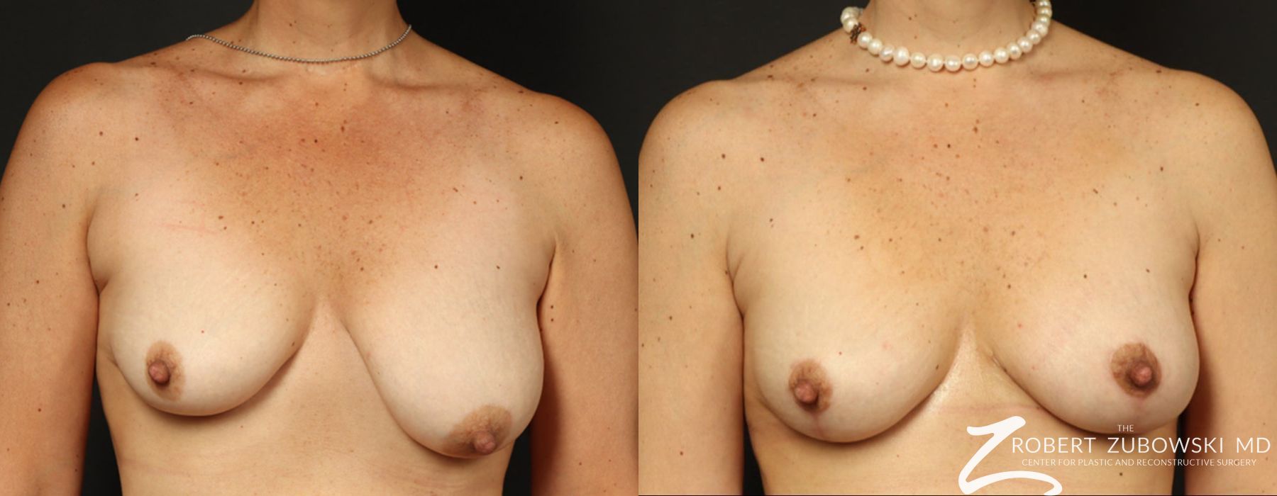 Mastopexy - Case 3736