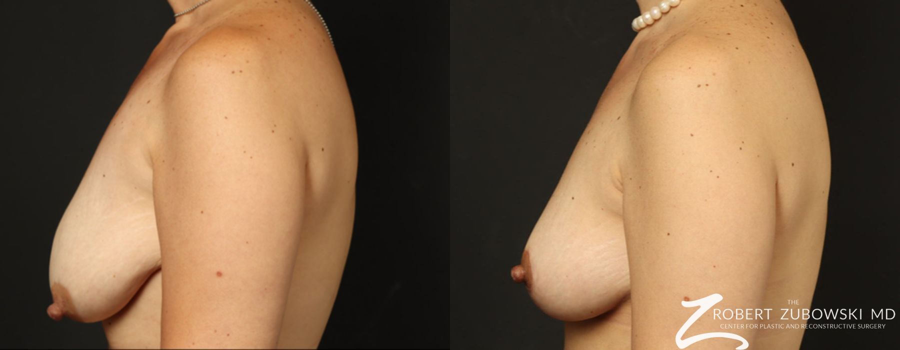 Mastopexy - Thumbnail 3