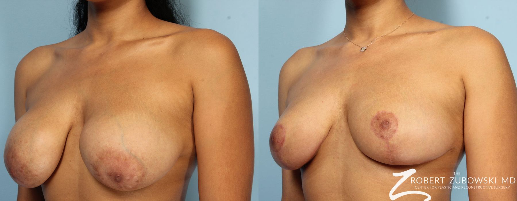 Mastopexy - Thumbnail 3