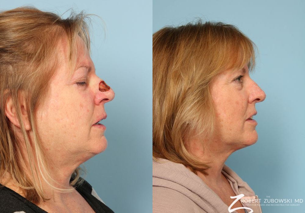 Mohs Closure - Thumbnail 2