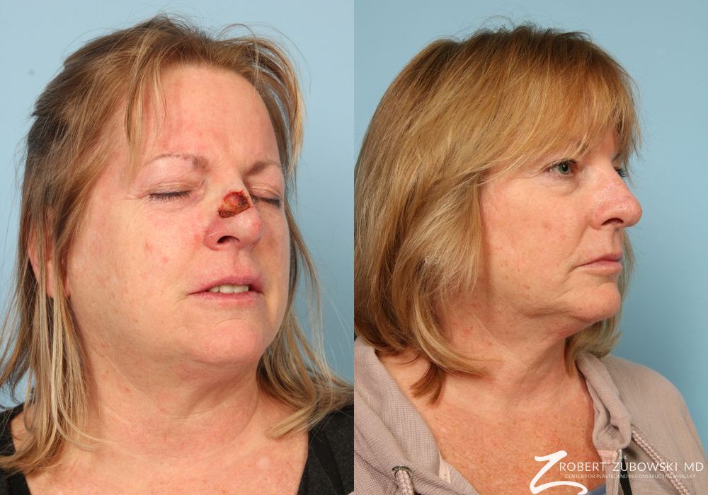 Mohs Closure - Thumbnail 3