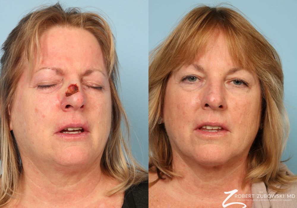 Mohs Closure - Case 3841