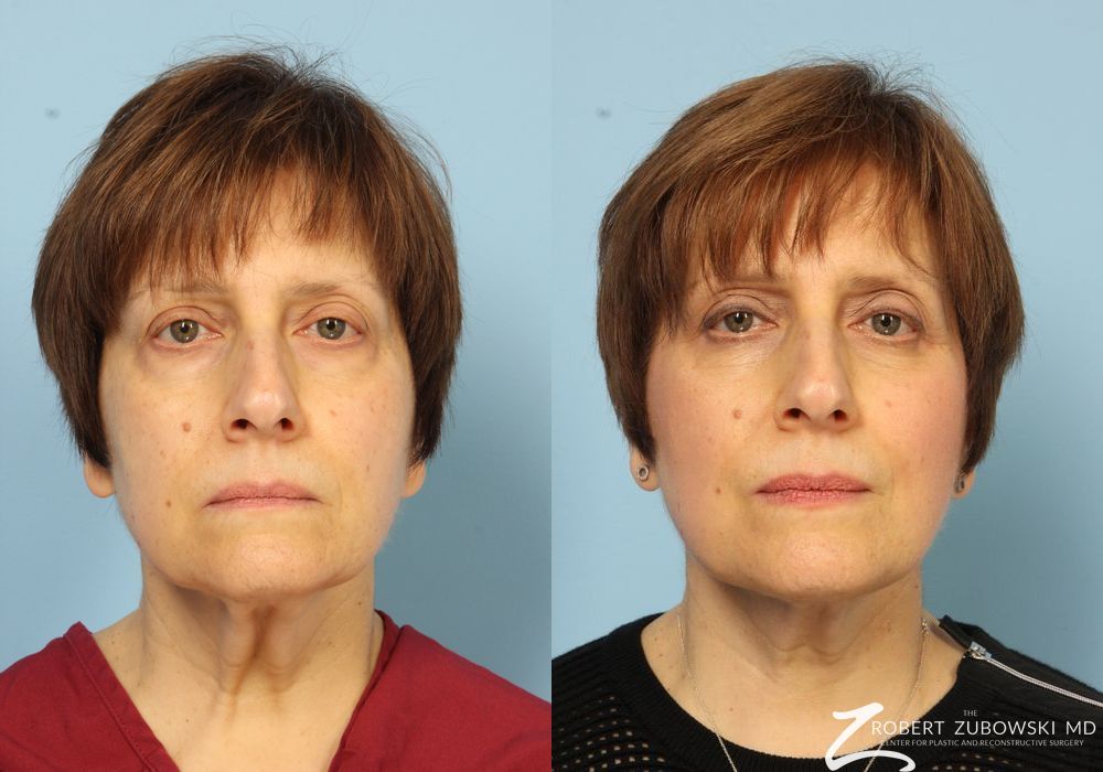 Neck Lift - Case 3849