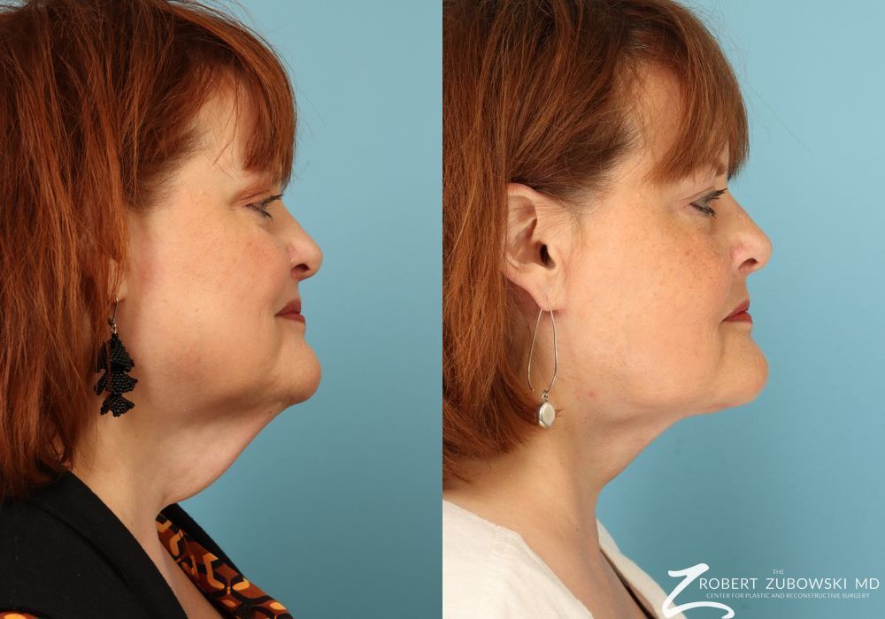 Neck Lift - Thumbnail 2