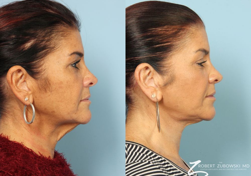 Neck Lift - Thumbnail 2