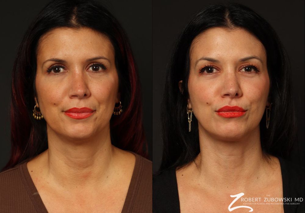 Neck Lift - Case 4304