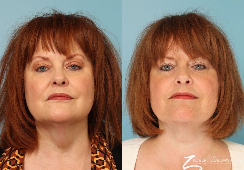 Neck Lift - Case 3853