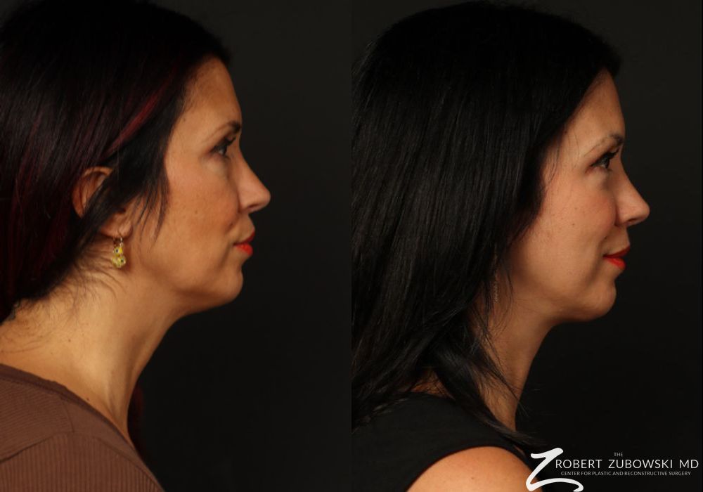 Blepharoplasty - Thumbnail 5