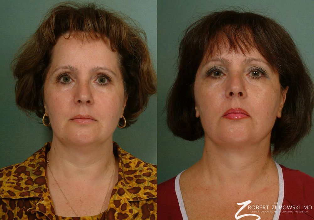 Neck Lift - Case 3848