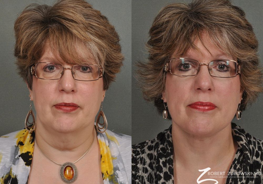 Neck Lift - Case 3847