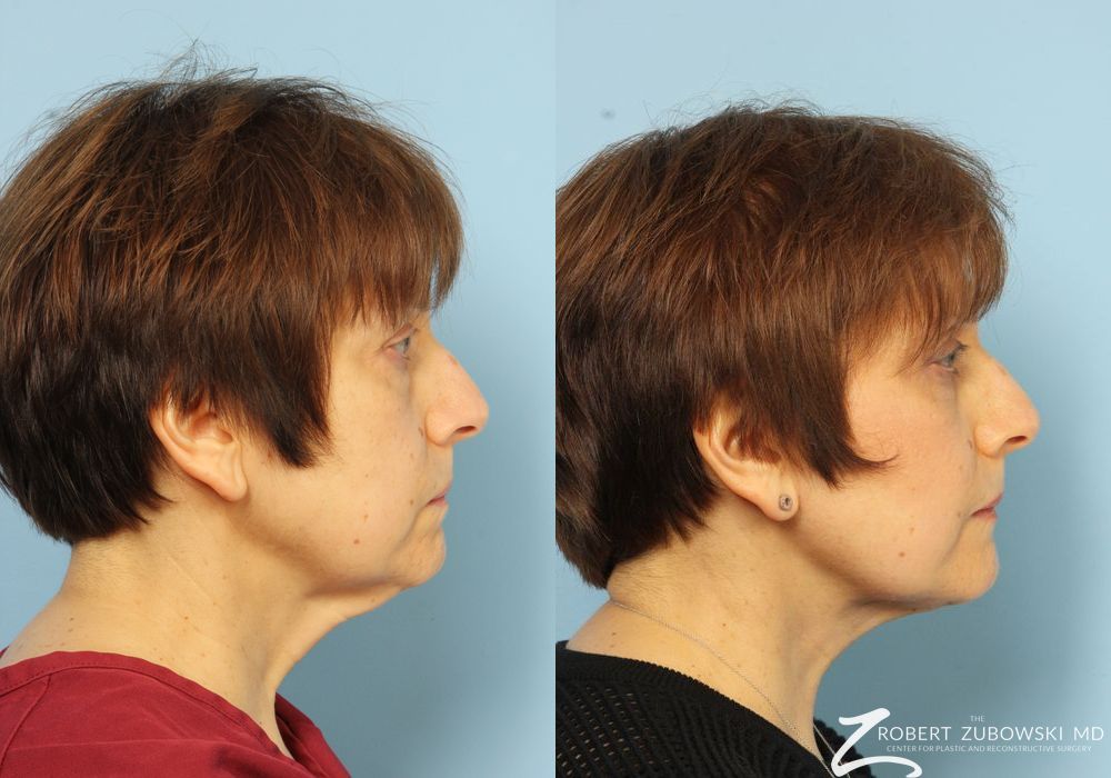 Neck Lift - Thumbnail 2