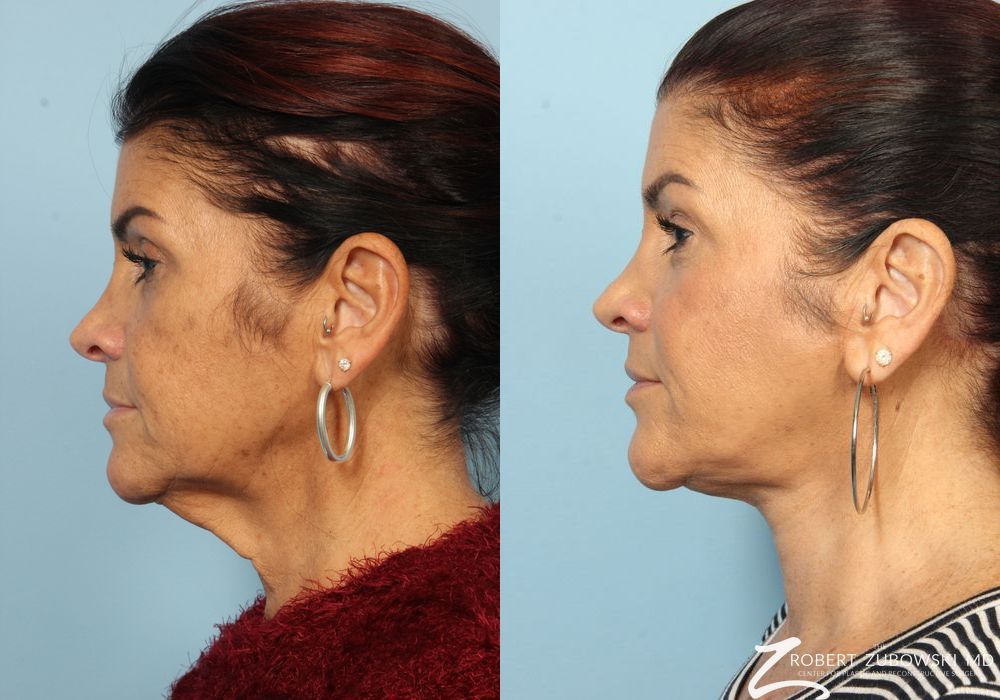 Neck Lift - Thumbnail 3