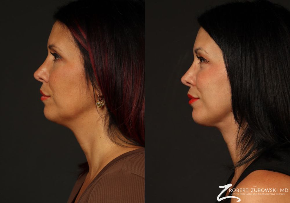 Neck Lift - Thumbnail 3