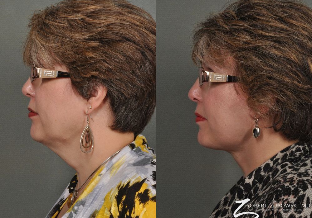 Neck Lift - Thumbnail 2