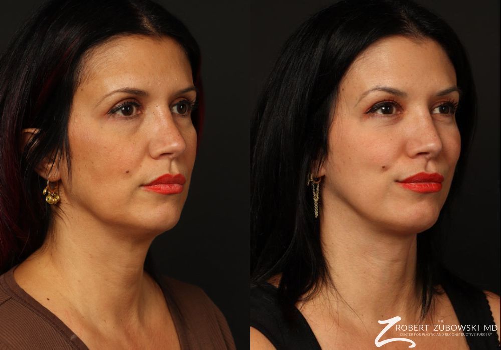 Neck Lift - Thumbnail 4