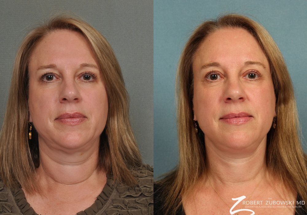 Neck Lift - Case 3844