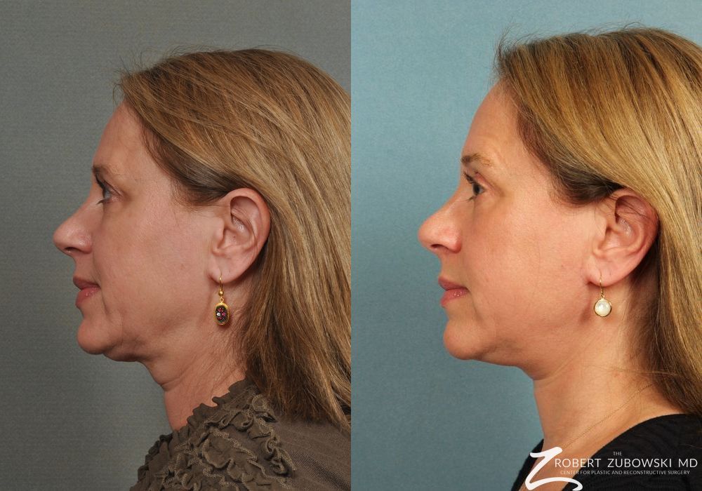 Neck Lift - Thumbnail 2